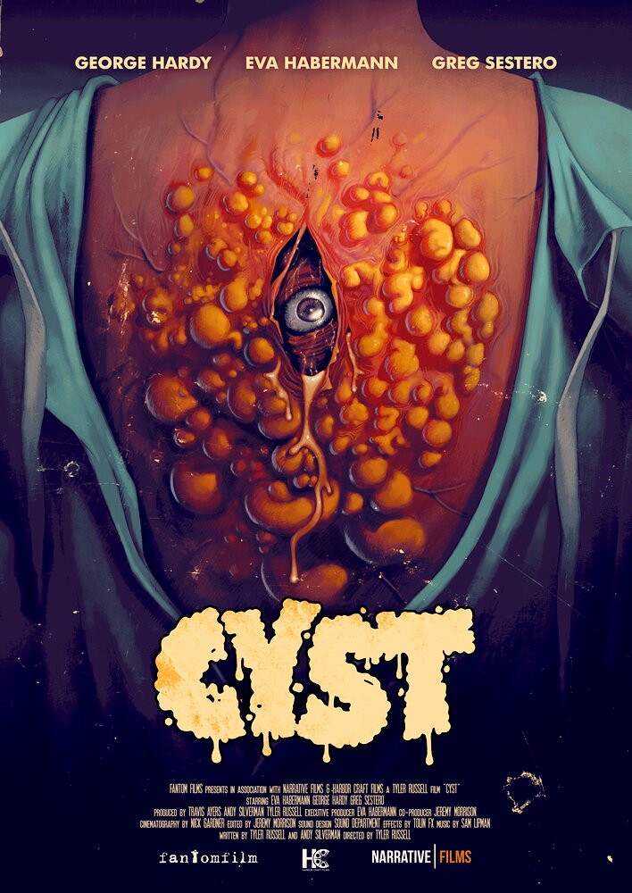 Cyst